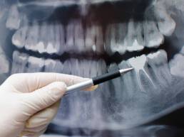 Zahnarzt Berlin Endodontie Wurzelbehandlung