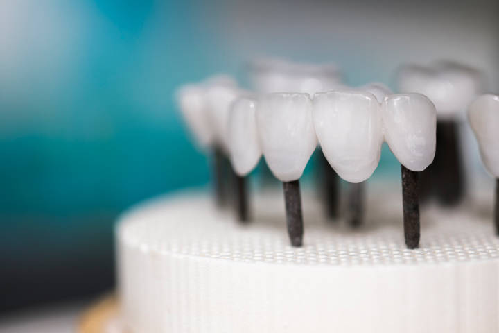 Zahnarzt Berlin Zahnersatz Kronen Prothesen Implantate