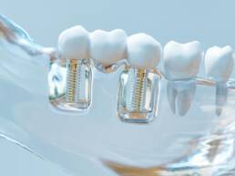 Zahnarzt Berlin Zahnersatz Kronen Prothesen Implantate